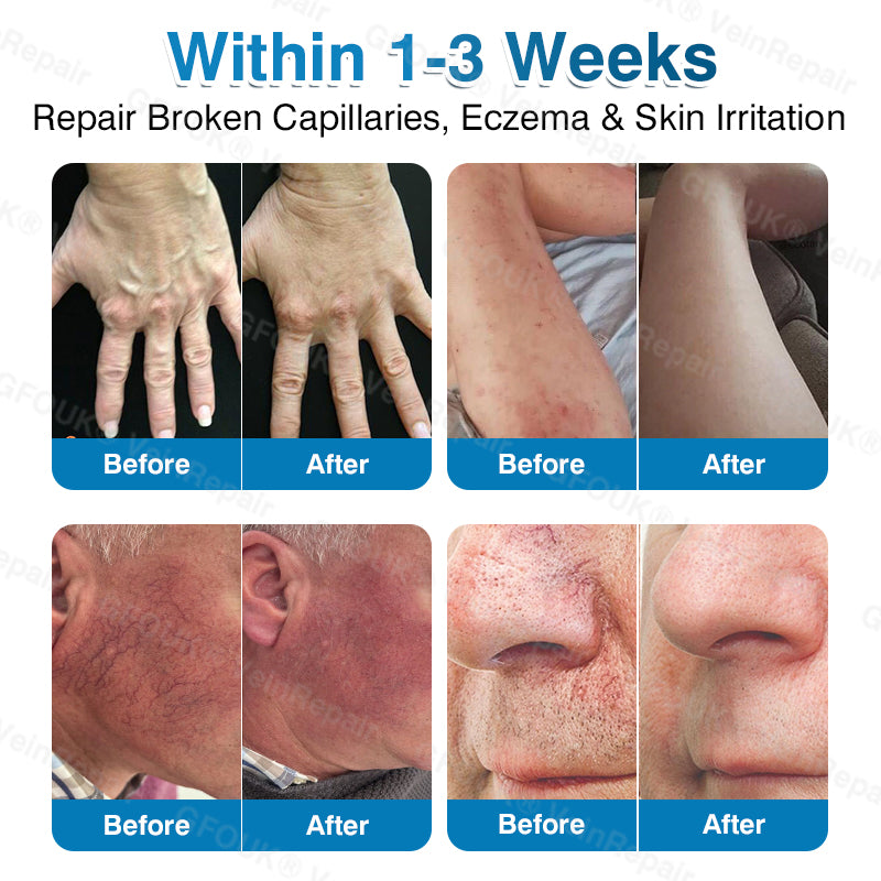🇺🇸🏆✅️🏃GFOUK® VeinRepair Microneedle Patch Roll⚡Instant Relief, Long-Term Results