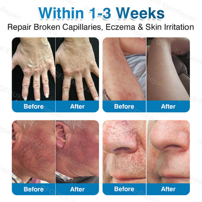 🇺🇸🏆✅️🏃GFOUK® VeinRepair Microneedle Patch Roll⚡Instant Relief, Long-Term Results