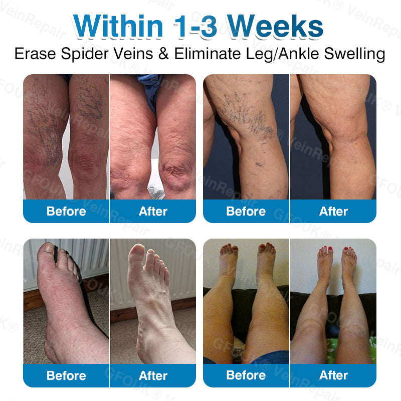 🇺🇸🏆✅️🏃GFOUK® VeinRepair Microneedle Patch Roll⚡Instant Relief, Long-Term Results