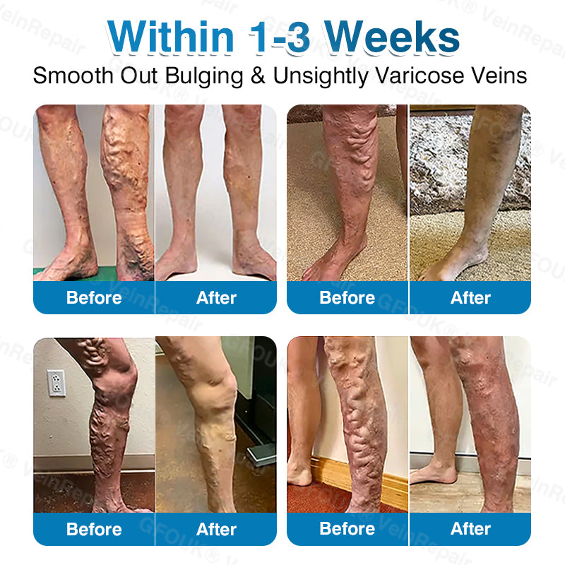 🇺🇸🏆✅️🏃GFOUK® VeinRepair Microneedle Patch Roll⚡Instant Relief, Long-Term Results
